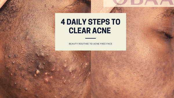 4 Daily Beauty Steps to Clear Acne.